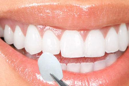 Dental Veneers Cimbak dental clinic Port harcourt